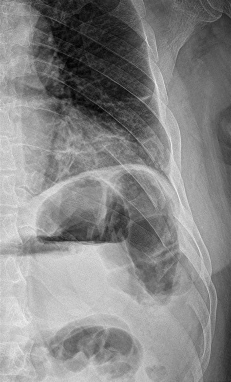 Rib fracture - wikidoc