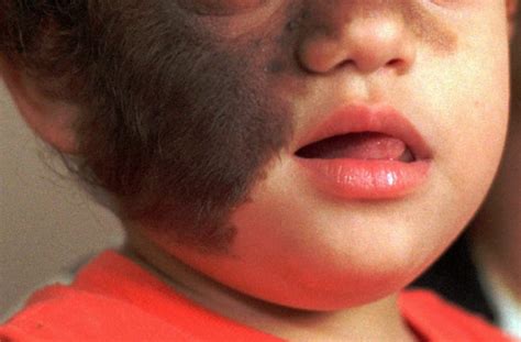 Werewolf Syndrome Babies In Spain Develop Rare Disease After Taking