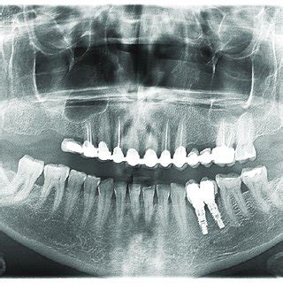 Peri Implant Radiolucencies Of Two Adjacent Implants Months After