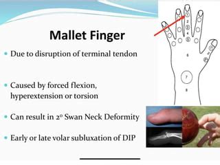 Extensor tendon injuries | PPT