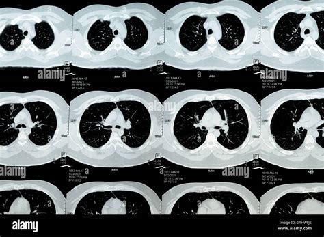 Multi Slice Ct Scan Of The Chest Showing Normal Study Normal