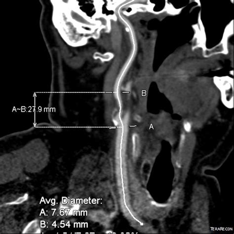 oblique incision – A Surgeon's Notes