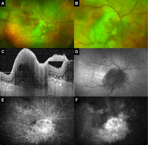 Multimodal Imaging Of The Right Eye At Initial Presentation Color