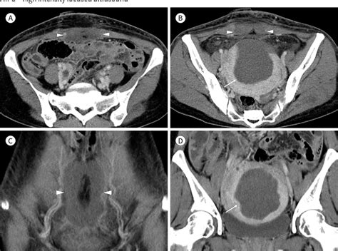 Figure 1 From Complication Following Ultrasound Guided High Intensity