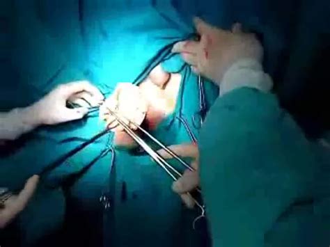 Surgeons Remove A Dildo From An Ass Bizarre Porn At ThisVid Tube