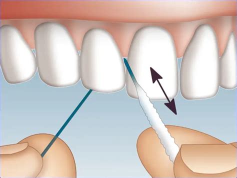 Seda Dental Tipos Y C Mo Usarlo Dental Gran V A