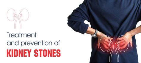 Natural Home Remedies to Prevent Kidney Stones