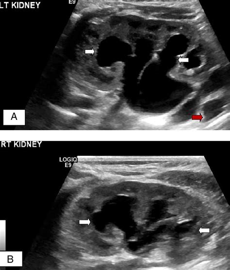 Bilateral Hydroureters And Hydronephrosis In A Neonate Adc Education And Practice Edition