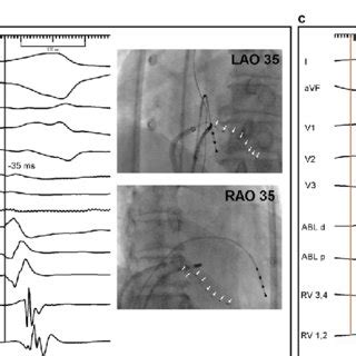 A A Lead Ecg Of Clinical Vt B Left Panel Intracardiac Egm At The