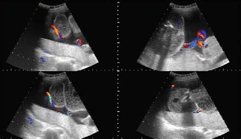 Trapcolor Doppler Blood Flow Mapping Of Two Vessels Umbilical Cord Of