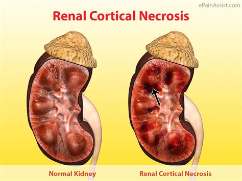 Renal Cortical Necrosis Rcn Types Causes Risk Factors Symptoms