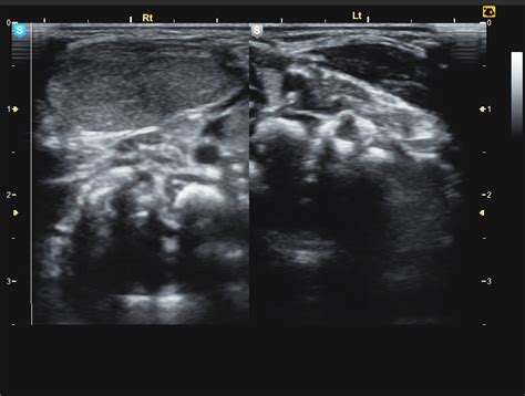 Fibromatosis Colli Image