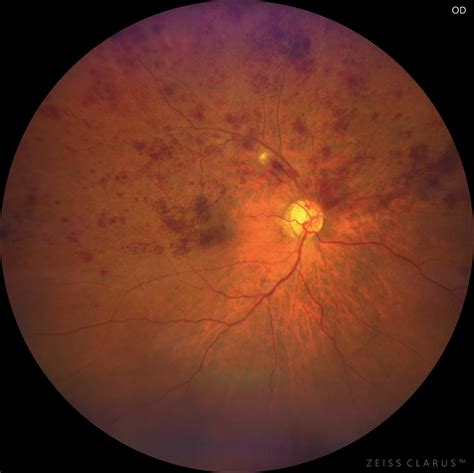 Retinal Vein Occlusion – Opthalmic Associates
