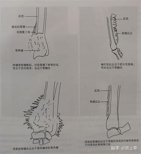 骨膜反应的x线片影像 知乎