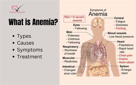 What Is Anemia? Types, Causes, Symptoms and Treatment - smarthealer.pk