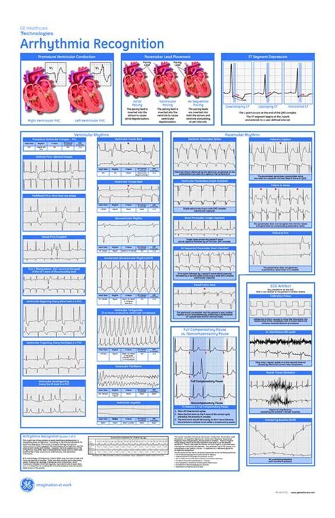 Arrhythmia Recognition Cardiac Cardiac Nursing Cardiology