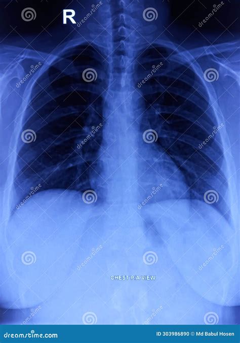 Cxr Chest X Ray Pa View Cervical Ribs Normal Findings Stock Photo