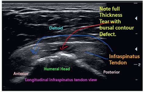 Ultrasound Guided Injection Technique For Infraspinatus Tendonitis