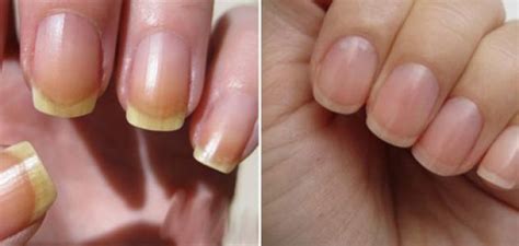 Nail Discoloration These Are Few Possible Reasons Why Your Nails Can