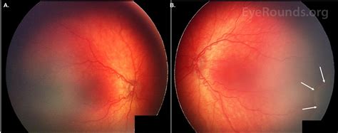 Retinopathy Of Prematurity