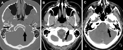 Figure 1 From Jugular Foramen Schwannoma Mimicking Paraganglioma Case