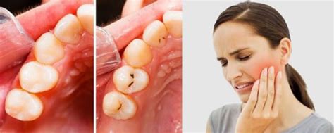 Causas De Las Caries Odontologia Peru