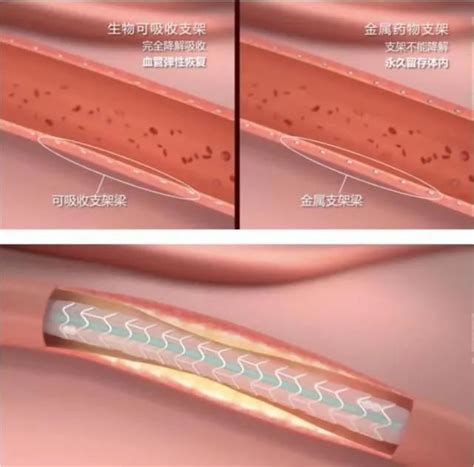 【健康晋州】晋州市人民医院心内科成功开展生物可降解支架植入术澎湃号·政务澎湃新闻 The Paper
