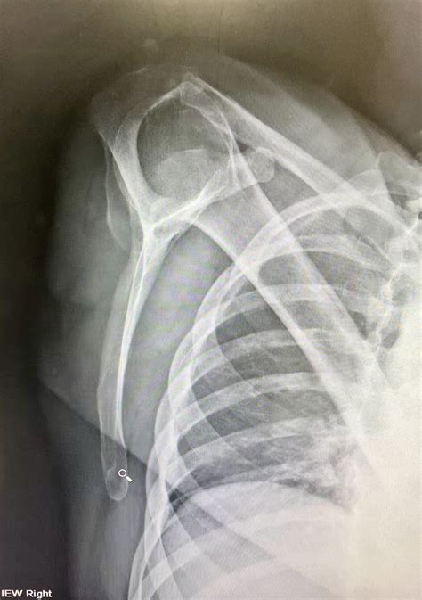 shoulder Y-view I’m kinda proud of :) : r/Radiology