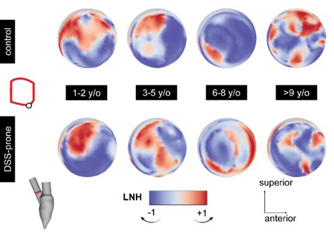 Figure E 12 Snapshots Of The Left Ventricular Outflow Tract Lvot