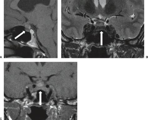 The Sella Turcica And Parasellar Region Radiology Key