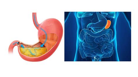 Spleen Stomach Pattern Differentiation Youtube