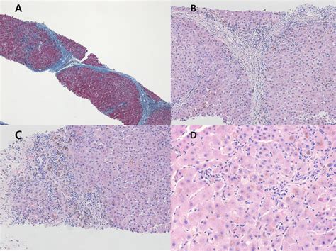 A Liver Biopsy Results Showing A Blue Fibrotic Band Trichrome Stain Download Scientific