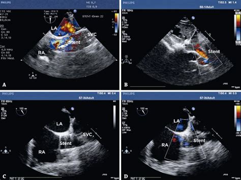 Transcatheter Occlusion Of Sinus Venosus Atrial Septal Defect A New