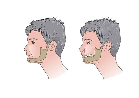 How Missing Teeth Affect Your Face Shape And Jawline Gordon Dental