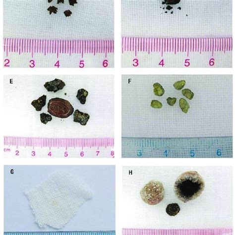 Pdf The Systematic Classification Of Gallbladder Stones