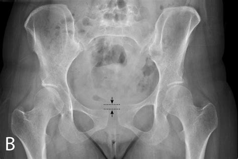 27 Year Old Female With Postpartum Symphysis Pubis Diastasis Ap Download Scientific Diagram