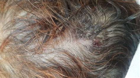 Squamous Cell Carcinoma On Seborheic Keratosis Of The Scalp Download