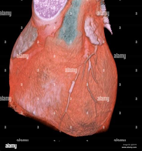 Human Heart 3d Ct Scan Hi Res Stock Photography And Images Alamy