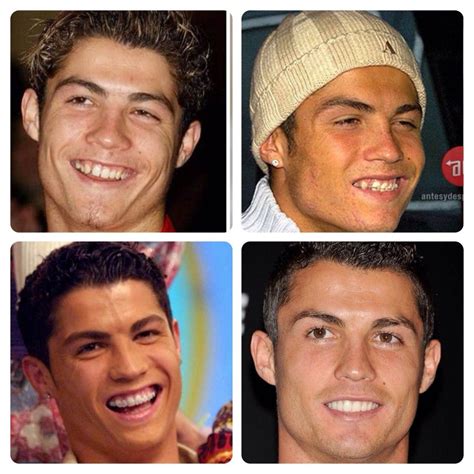 Cristiano Ronaldo Before Surgery