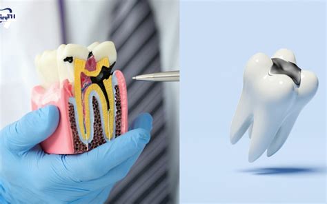 What Are 3 Final Causes And Treatment Of Black Line On Teeth - Infoteeth