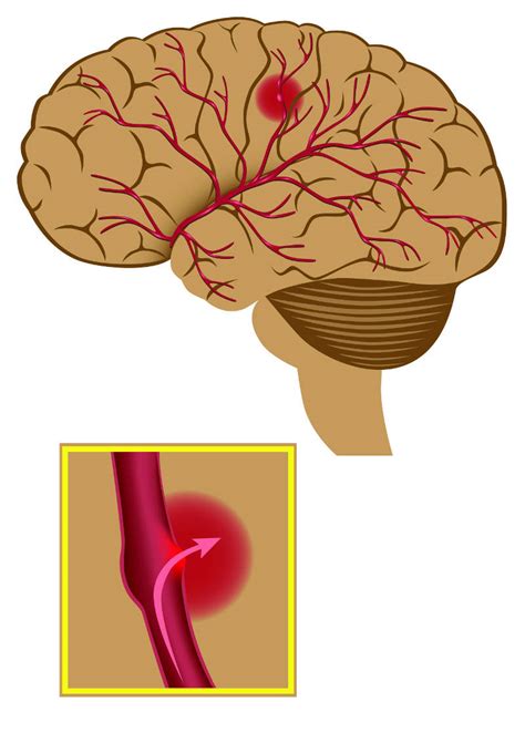 Brain Aneurysm Headway