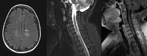 Research | Multiple Sclerosis Center