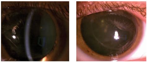 Corneal Transplant Rejection Treatment