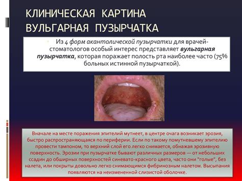 Пузырчатка. Этиология. Патогенез. Клиническая картина. Гистопатология ...