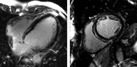 Myocardial Fibrosis Why Image How To Image And Clinical Implications