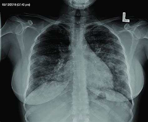 Pa Chest X Ray Demonstrating Bilateral Perihilar Reticular And Airspace