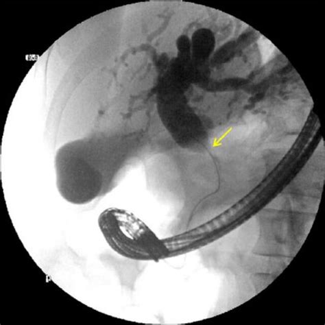 Endoscopic Retrograde Cholangiopancreatography ERCP Sagittal View