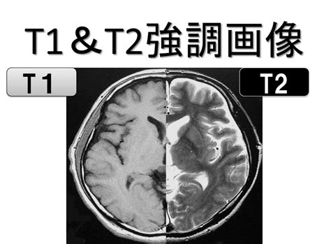 脳画像におけるct・mriの見方！！みるべきポイントさえ押さえれば、脳画像は簡単に見れる！！ リハアイデア