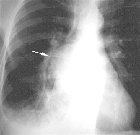 Imaging Of Cystic Masses Of The Mediastinum Radiographics