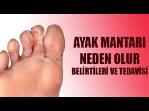 AYAK MANTARI TEDAVİSİ Ayak Mantarı YouTube